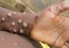 Monkeypox in Delhi: