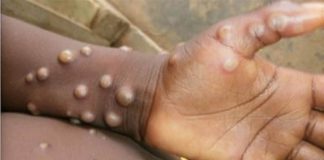 Monkeypox in Delhi: